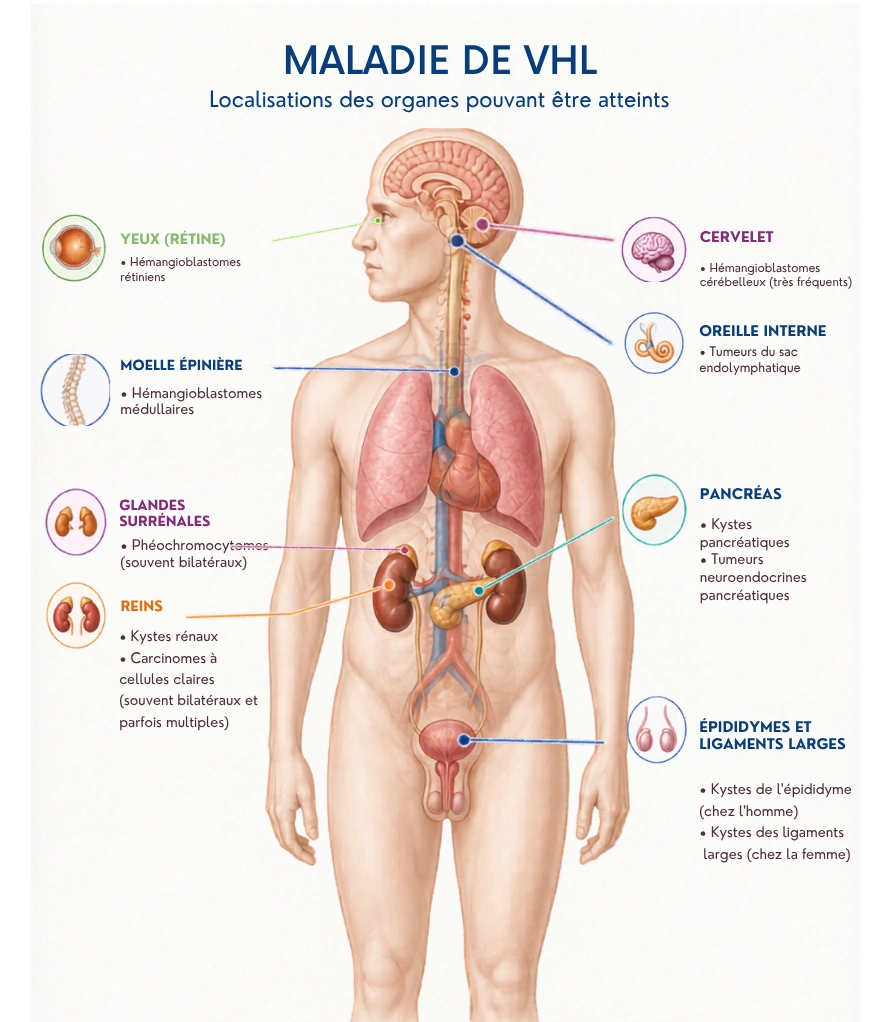 maladie de VHL - localisation des organes pouvant être atteints